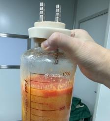 武安水动力吸脂手术要做多久？